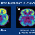 Brain_metabolism_and_drug_addiction