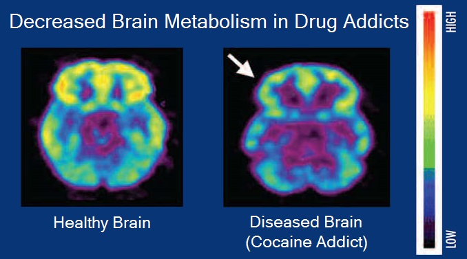 Brain_metabolism_and_drug_addiction